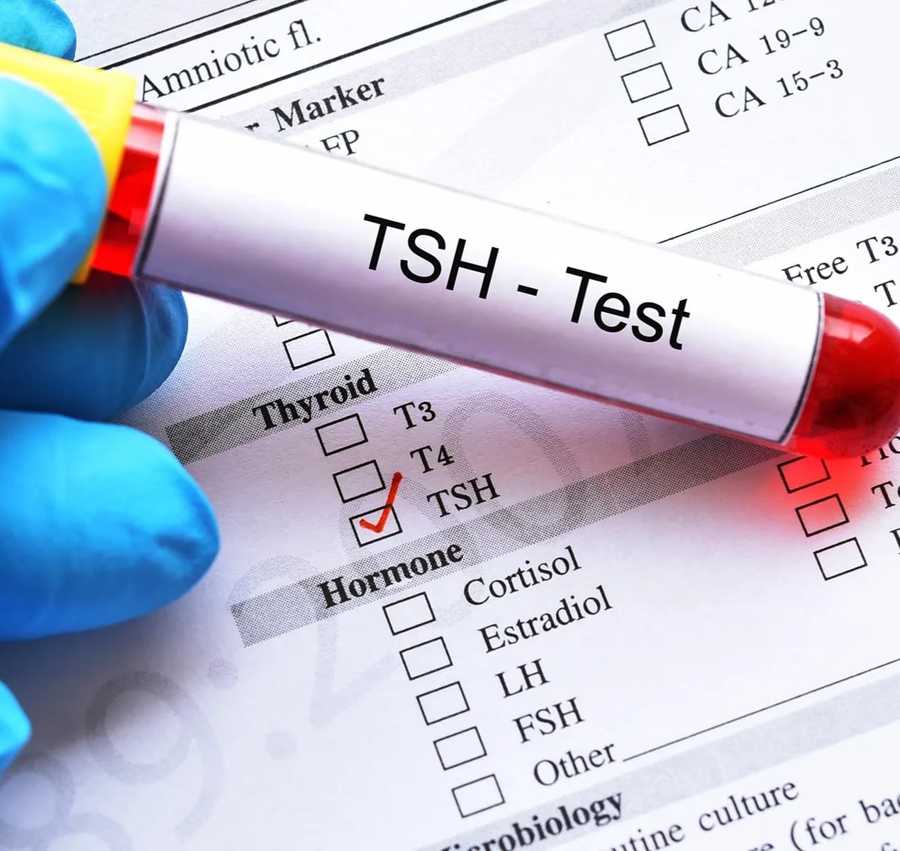 Thyroid Stimulating Hormone TSH test